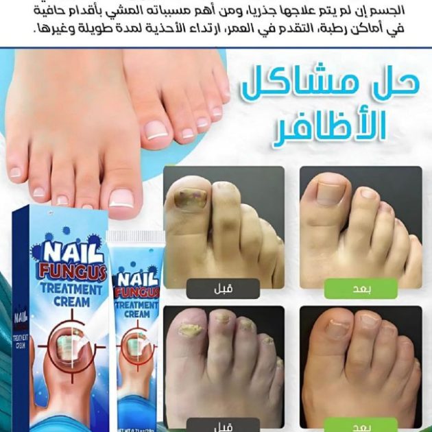 كريم علاجي مخصص لفطريات الأظافر